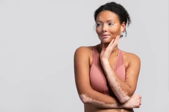 Kvinde med vitiligo poserer selvsikkert med bar hud