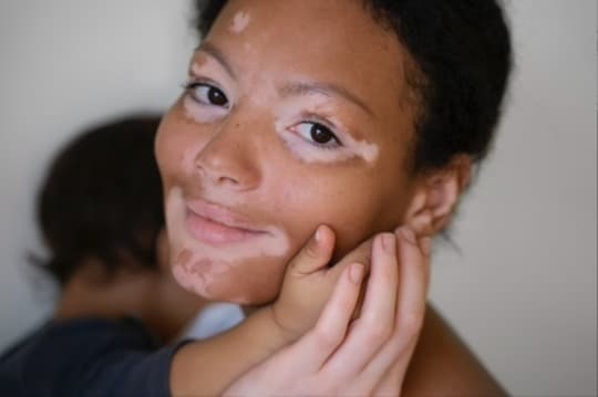 Permanent makeup for vitiligo – Er der en løsning til at camouflere det med succes?