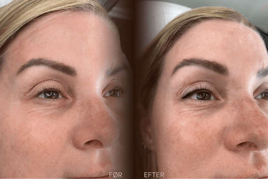 Før og efter permanent eyeliner med diskret vinge på yngre kvinde