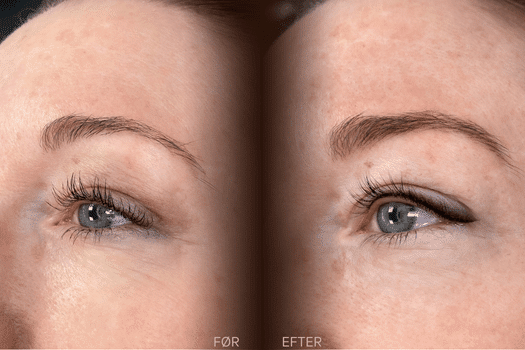 Før og efter permanent eyeliner med toning på øvre vippekant